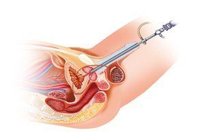 Who Needs Laparoscopic Hysterectomy? Conditions & Symptoms Explained